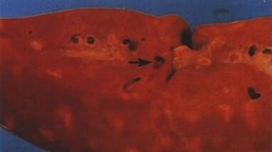 wat Parasiten kënnen an der mënschlecher Liewer liewen